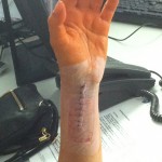 Tina's arm post surgery